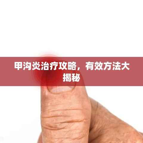 甲沟炎治疗攻略,有效方法大揭秘